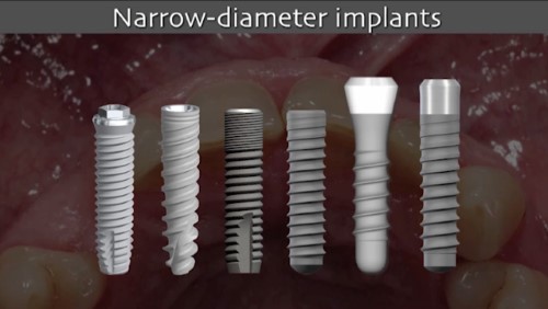 Implication of different implant types